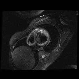 File:Non-compaction of the left ventricle (Radiopaedia 38868-41062 D 12).jpg
