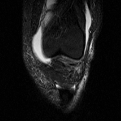 File:Non-displaced patella fracture (Radiopaedia 15932-15582 Coronal STIR 7).jpg