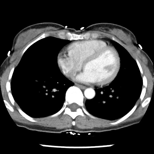 File:Non-small cell lung cancer with miliary metastases (Radiopaedia 23995-24193 A 27).jpg