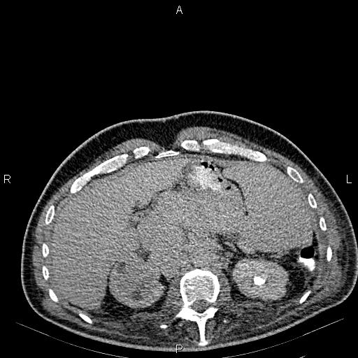 Non Hodgkin lymphoma in a patient with ankylosing spondylitis (Radiopaedia 84323-99621 Axial C+ delayed 21).jpg