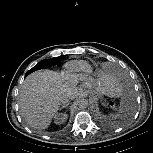 File:Non Hodgkin lymphoma in a patient with ankylosing spondylitis (Radiopaedia 84323-99621 Axial non-contrast 26).jpg