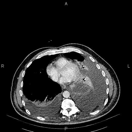File:Non Hodgkin lymphoma in a patient with ankylosing spondylitis (Radiopaedia 84323-99621 B 23).jpg