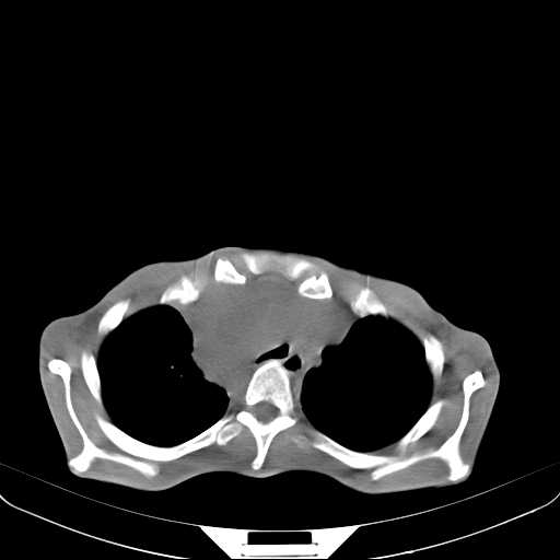 File:Non hodgkin lymphoma of the mediastinum (Radiopaedia 20814-20729 Axial non-contrast 8).jpg