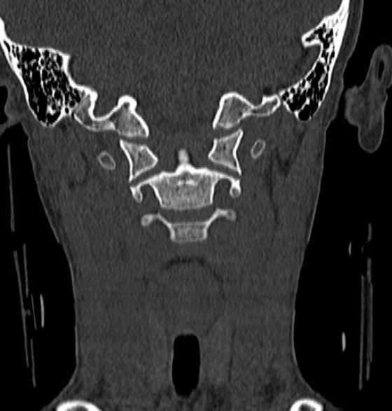 File:Normal CT cervical spine - 12-year-old (Radiopaedia 55352-61775 Coronal bone window 71).jpg