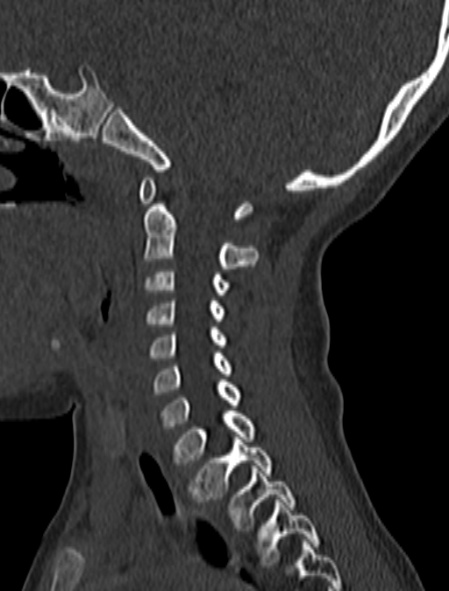 Normal CT cervical spine - pediatric (Radiopaedia 52549-58462 Sagittal bone window 133).jpg