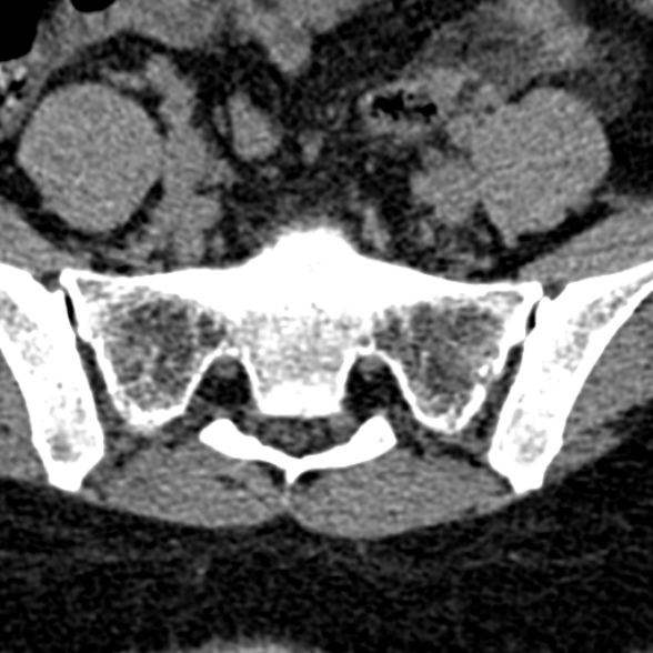 Normal CT lumbar spine (Radiopaedia 53981-60118 Axial non-contrast 95).jpg