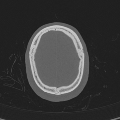 Normal CT skull (Radiopaedia 40798-43459 A 138).png