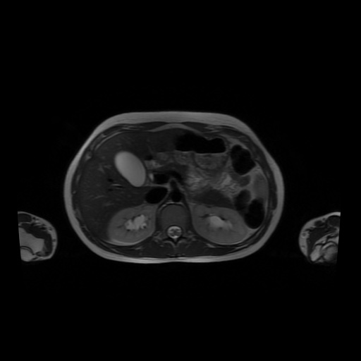File:Normal MRI abdomen in pregnancy (Radiopaedia 88001-104541 Axial T2 17).jpg