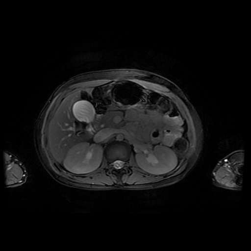 File:Normal MRI abdomen in pregnancy (Radiopaedia 88001-104541 D 18).jpg
