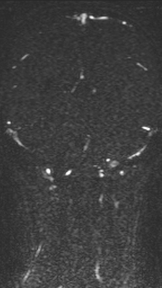 Normal MRI brain with MRV- teenager (Radiopaedia 49425-54553 Coronal MRV 168).jpg
