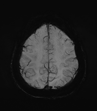 Normal MRI internal auditory canal (Radiopaedia 41613-44525 Axial SWI MIP 63).png