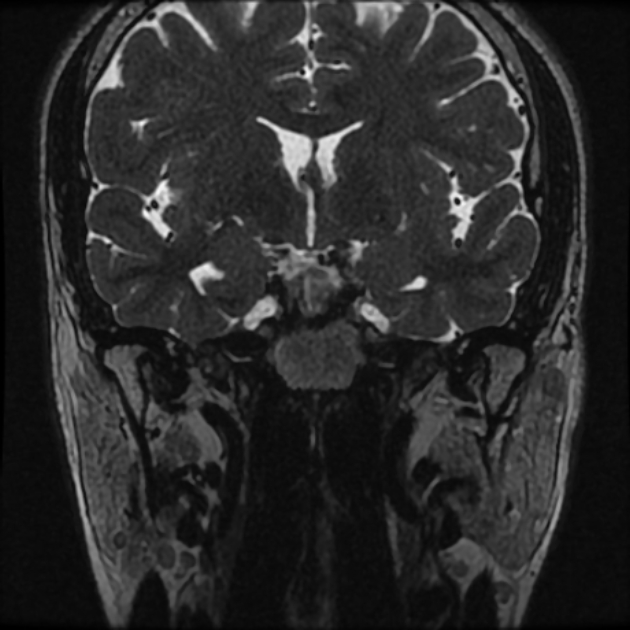 Normal MRI petrous (Radiopaedia 91317-108949 Coronal T2 15).jpg