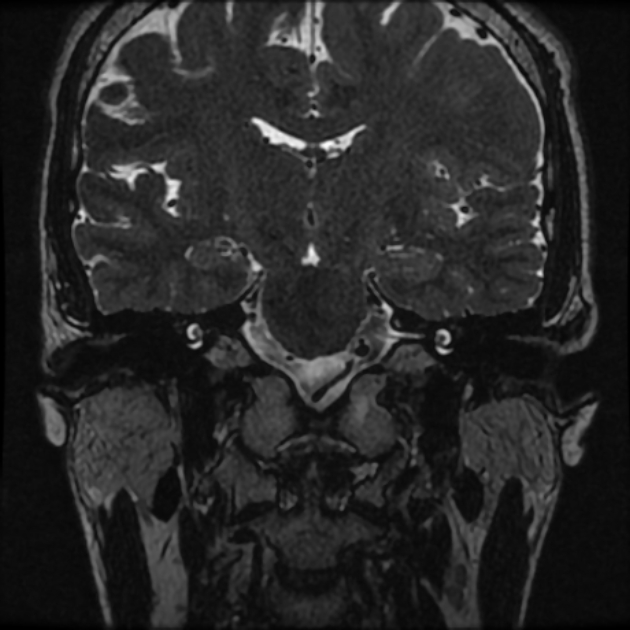 Normal MRI petrous (Radiopaedia 91317-108949 Coronal T2 41).jpg
