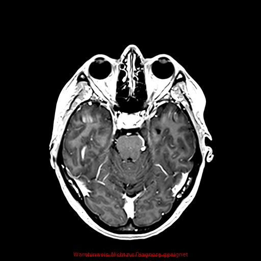 Normal adult brain MRI (non-enhanced and contrast-enhanced) (Radiopaedia 75262-86379 Axial T1 C+ 83).jpg