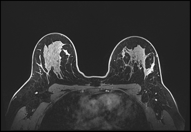 Normal breast MRI - dense breasts (Radiopaedia 80454-93850 C 145).jpg