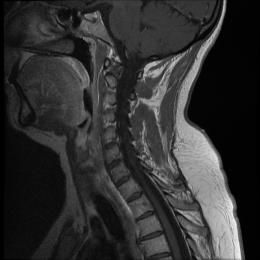 File:Normal cervical and thoracic spine MRI (Radiopaedia 35630-37156 Sagittal T1 C+ 8).png