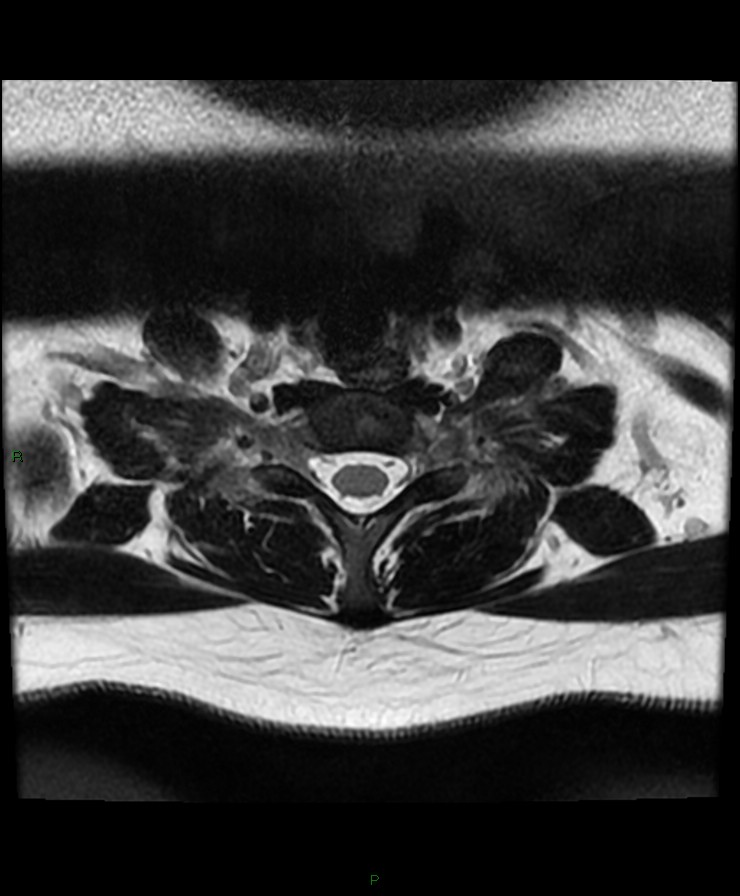 Normal cervical spine MRI (Radiopaedia 80146-93454 Axial T2 88).jpg