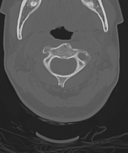 Normal cervical spine MRI (including Dixon) (Radiopaedia 42762-45926 Axial bone window 17).png