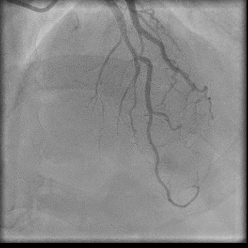 Normal coronary angiogram (DSA) (Radiopaedia 63081-71571 E 61).jpg