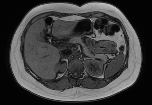 File:Normal liver MRI with Gadolinium (Radiopaedia 58913-66163 B 19).jpg