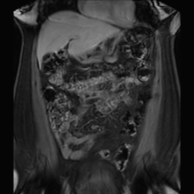 Normal liver MRI with Gadolinium (Radiopaedia 58913-66163 P 28).jpg