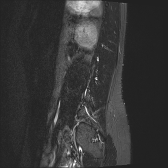 File:Normal lumbar spine MRI- 3 T (Radiopaedia 53280-59250 Sagittal STIR 23).jpg