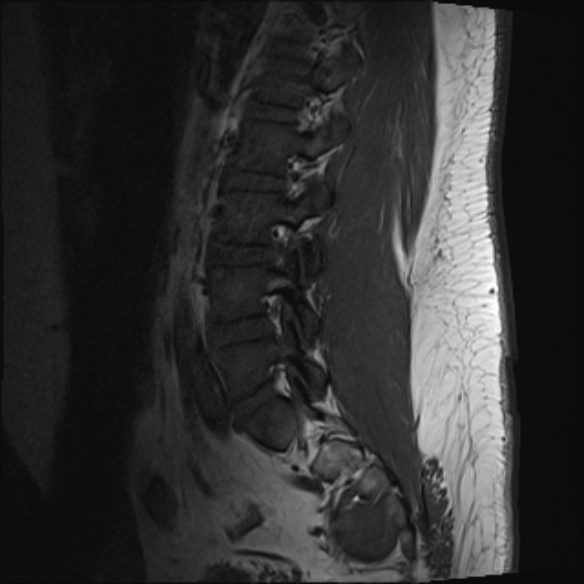 File:Normal lumbar spine MRI (Radiopaedia 47857-52609 Sagittal T1 15).jpg