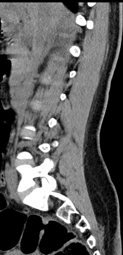 Normal lumbosacral CT (Radiopaedia 37923-39867 E 71).png