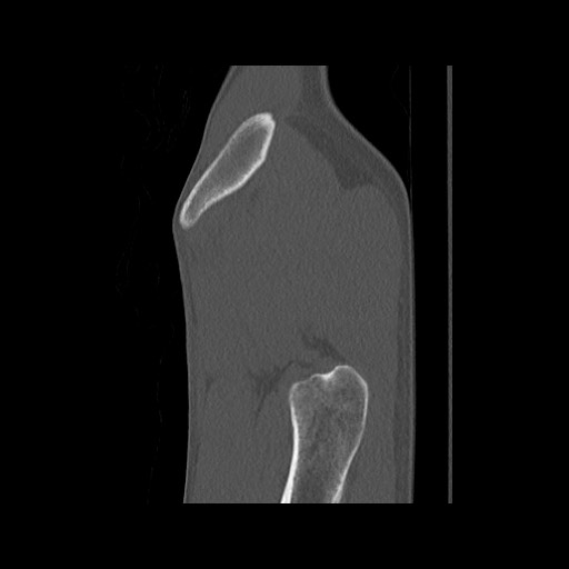 Normal pelvis (Radiopaedia 51473-57238 Sagittal bone window 14).jpg