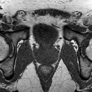 File:Normal prostate (MRI) (Radiopaedia 29986-30535 Axial T1 9).jpg