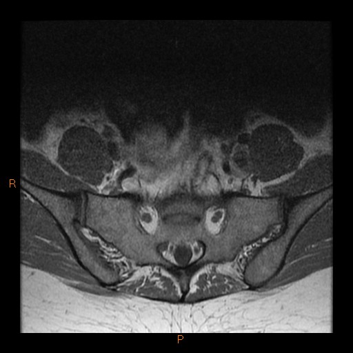File:Normal spine MRI (Radiopaedia 77323-89408 Axial T1 29).jpg