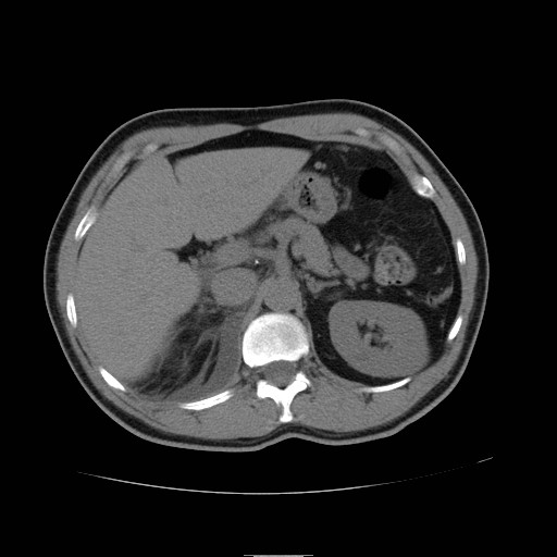 File:Obstructed kidney with perinephric urinoma (Radiopaedia 26889-27066 Axial non-contrast 11).jpg