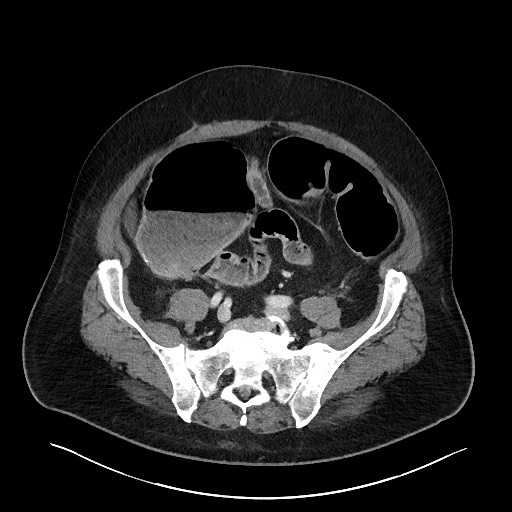 Obstructing sigmoid adenocarcinoma (Radiopaedia 58465-65619 A 120).jpg