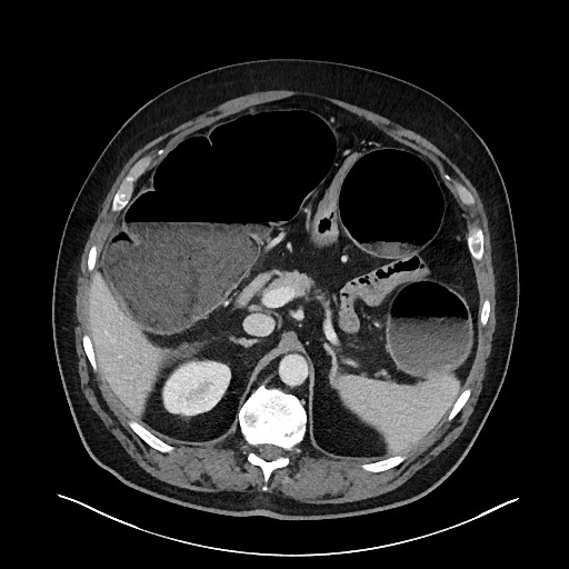 Obstructing sigmoid adenocarcinoma (Radiopaedia 58465-65619 A 50).jpg