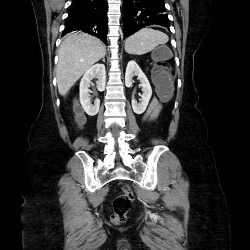 Obstructive distal colonic adenocarcinoma causing cecal perforation (Radiopaedia 86830-102989 C 125).jpg