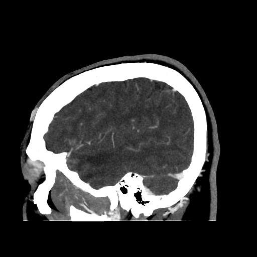 Occipital extradural hematoma simulating venous sinus thrombosis (Radiopaedia 46514-50964 D 62).jpg