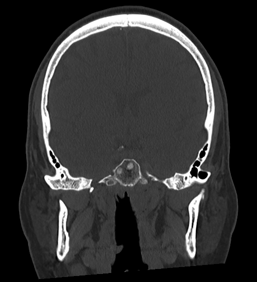 Occipital spur and Currarino type A atlas anomaly (Radiopaedia 87027-103285 Coronal bone window 75).jpg