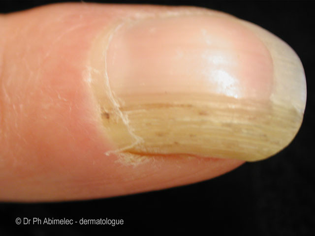 File:© Dr Ph Abimelec – dermatologue (DermNet NZ hair-nails-sweat-a-onychomatricoma).jpg