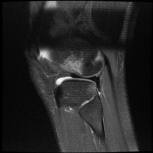 File:ACL acute full thickness tear - deep lateral femoral sulcus sign (Radiopaedia 38594-40740 Sagittal PD fat sat 19).jpg