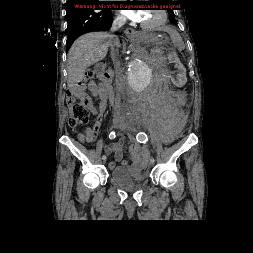 File:Abdominal aortic aneurysm- extremely large, ruptured (Radiopaedia 19882-19921 Coronal C+ arterial phase 52).jpg