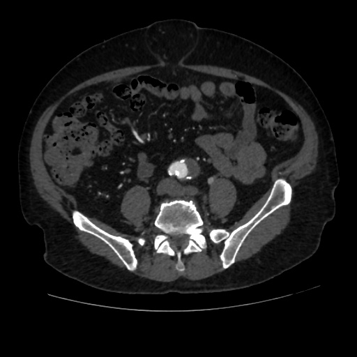 File:Abdominal aortic aneurysm (Radiopaedia 57318-64259 Axial C+ arterial phase 49).jpg