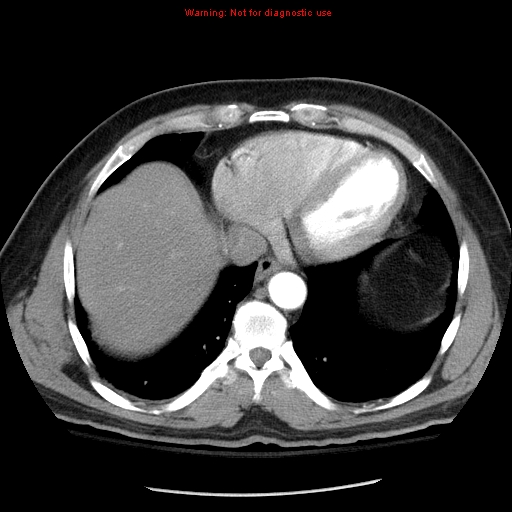 File:Abdominal aortic aneurysm (Radiopaedia 8190-9038 Axial C+ arterial phase 6).jpg