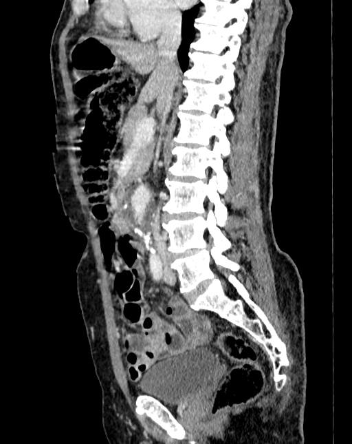 Abdominal aortic aneurysm (Radiopaedia 83581-98689 Sagittal C+ portal venous phase 40).jpg