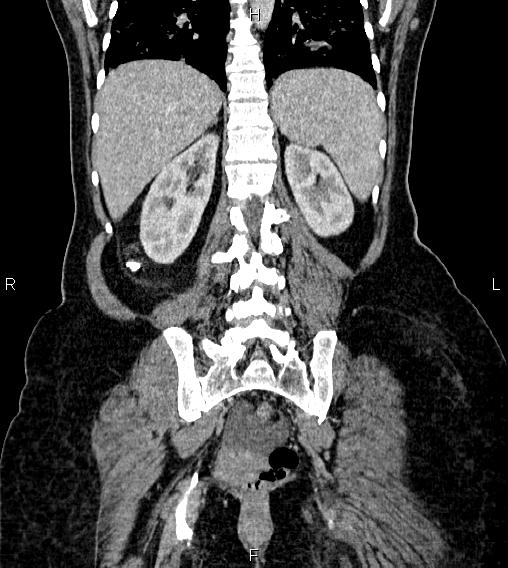 Abdominal lymphoma with sandwich sign (Radiopaedia 84378-99704 Coronal C+ portal venous phase 51).jpg
