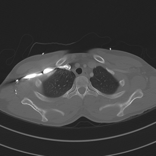 Abdominal multi-trauma - devascularised kidney and liver, spleen and pancreatic lacerations (Radiopaedia 34984-36486 I 17).png