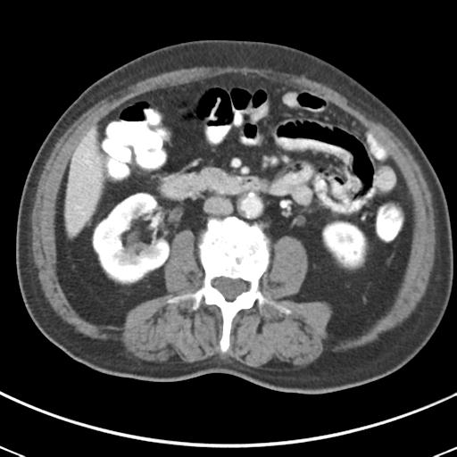 Abdominal wall metastasis from colorectal carcinoma (Radiopaedia 31016-31717 Axial C+ portal venous phase 37).jpg