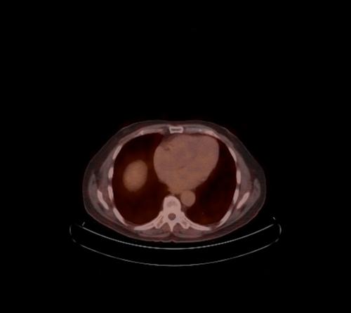 Abdominal wall metastasis from colorectal carcinoma (Radiopaedia 31016-31719 C 99).jpg