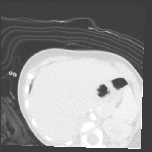 File:Aberrant left pulmonary artery (pulmonary sling) (Radiopaedia 42323-45435 Axial lung window 44).jpg