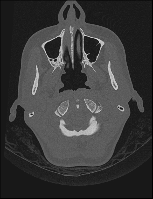 Aberrant right internal carotid artery (Radiopaedia 65191-74198 Axial non-contrast 5).jpg