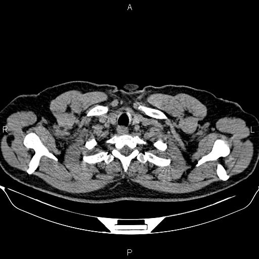 Aberrant right subclavian artery (Radiopaedia 87093-103354 Axial non-contrast 6).jpg